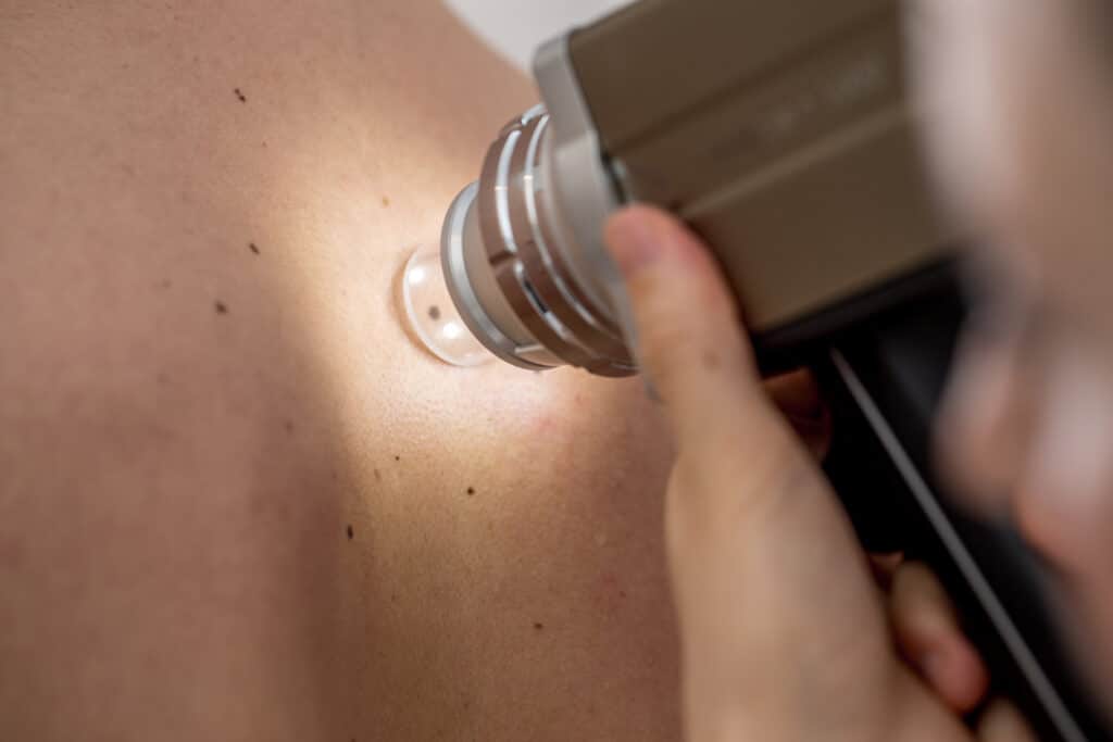 Close-up of a Dermatologist Mole Mapping on Patient's Back.