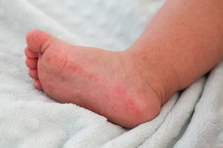 A small child with a red rash on the leg sits on the bed. Children is allergies. Enterovirus.